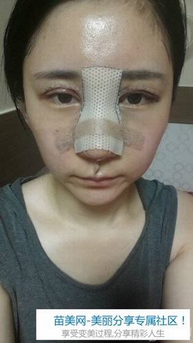 埋线法双眼皮+Misko隆鼻+鼻尖移植软骨1个月后