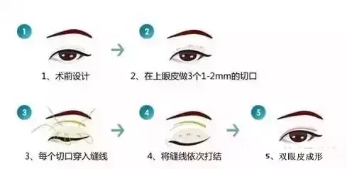 双眼皮手术：韩式、切开、埋线，哪个更好？