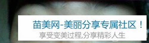 切开法双眼皮+开内眼角+硅胶隆鼻整形手术6个月后