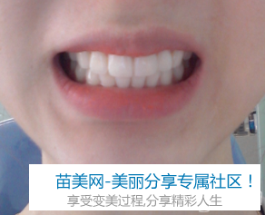 Laminate牙齿矫正+冷光美白治疗后记