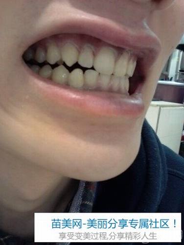 Laminate牙齿整形手术