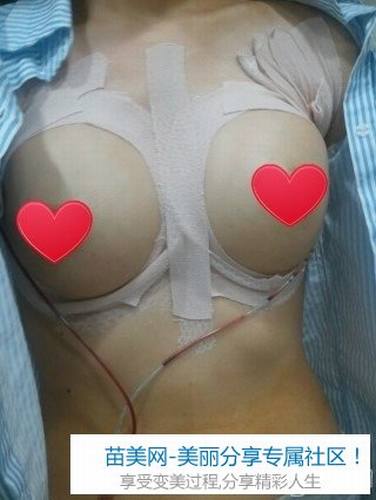 水滴形假体隆胸整形手术后记
