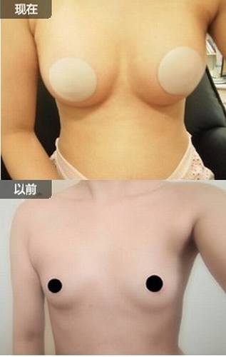 假体隆胸整形手术３个月后