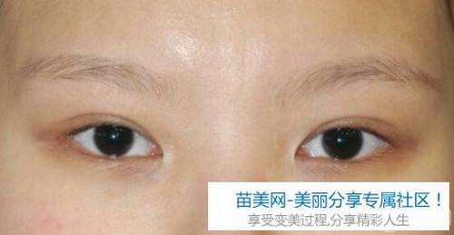 开内眼角重建+双眼皮修复整形手术1个月后