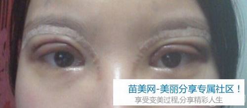 开内眼角重建+双眼皮修复整形手术1个月后