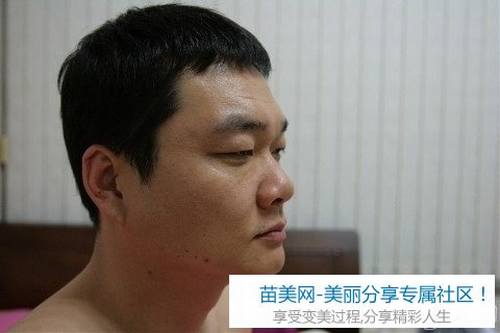 切开法双眼皮+硅胶隆鼻整形手术2个月后