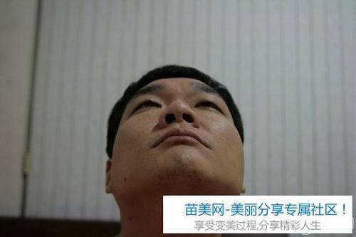 切开法双眼皮+硅胶隆鼻整形手术2个月后